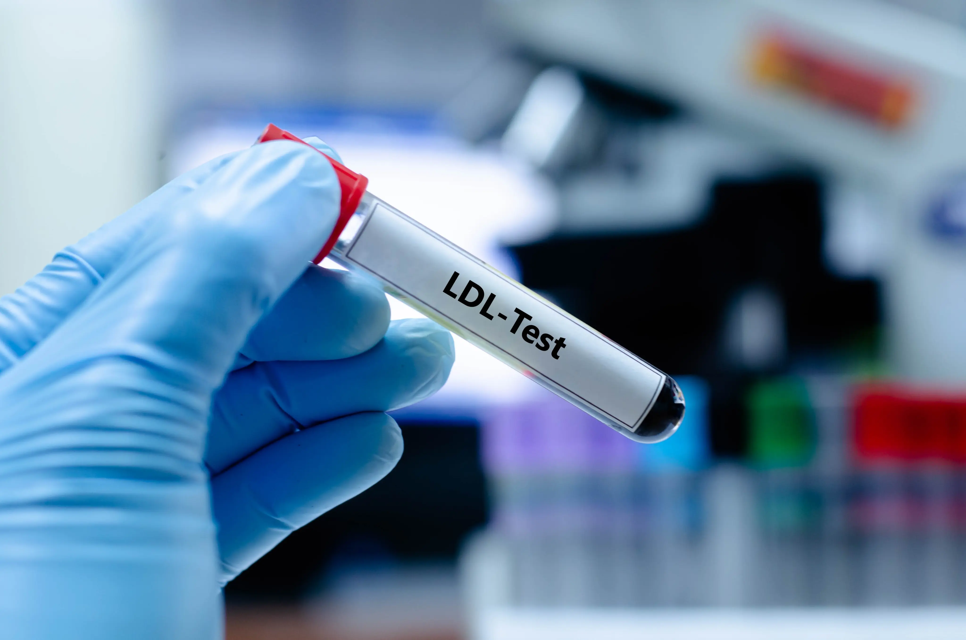 Advanced Lipid Testing and Management